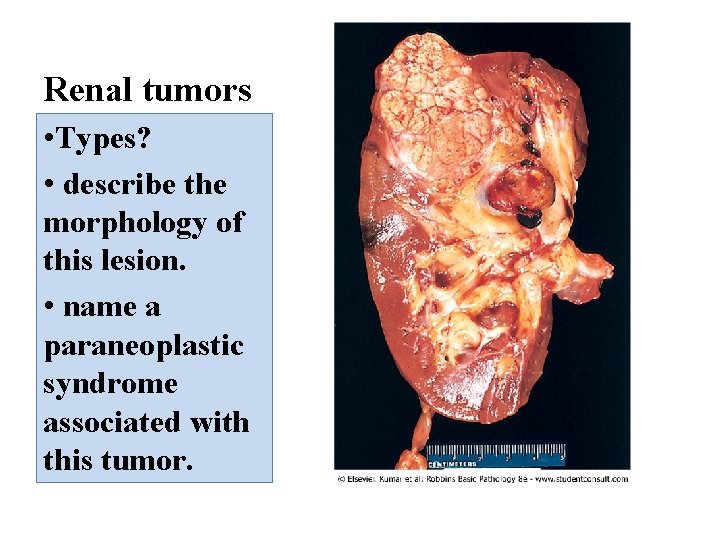 Renal tumors • Types? • describe the morphology of this lesion. • name a