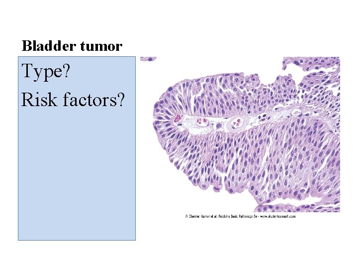Bladder tumor Type? Risk factors? 