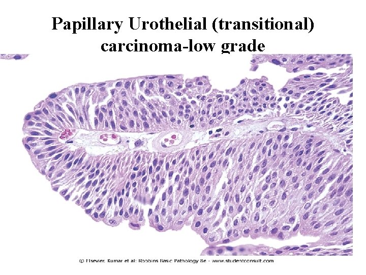 Papillary Urothelial (transitional) carcinoma-low grade 