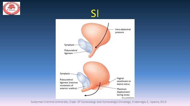 SI Suleyman Demirel University, Dept. Of Gynecology and Gynecologic Oncology, Erdemoglu E, Isparta, 2013