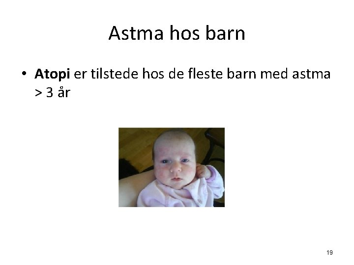 Astma hos barn • Atopi er tilstede hos de fleste barn med astma >