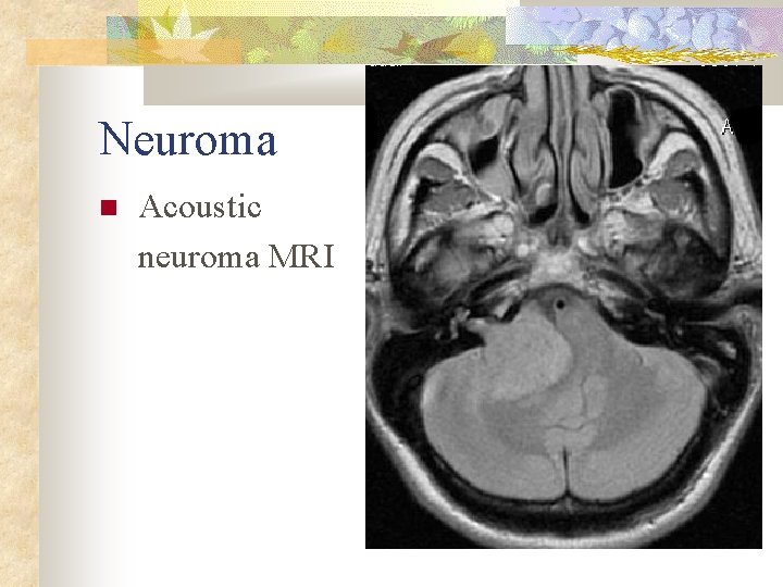 Neuroma Acoustic neuroma MRI 