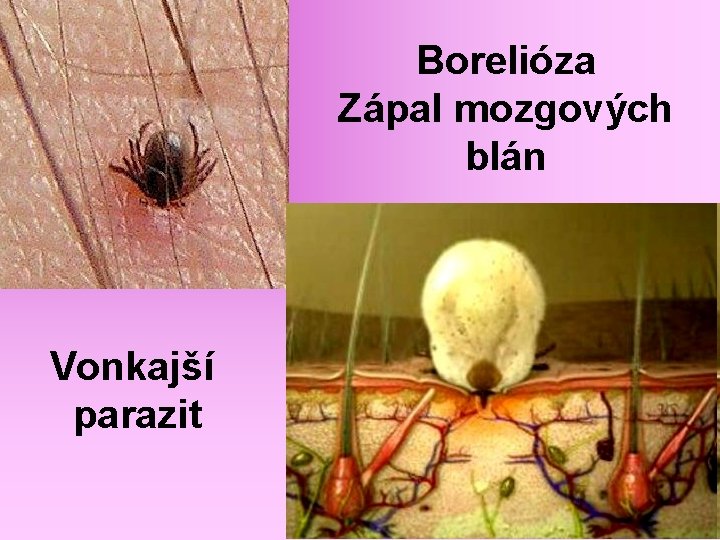 Borelióza Zápal mozgových blán Vonkajší parazit 
