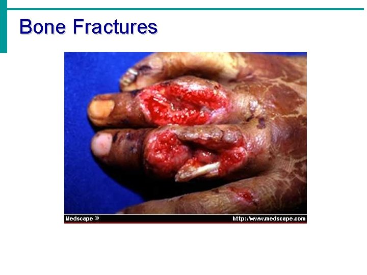 Bone Fractures 