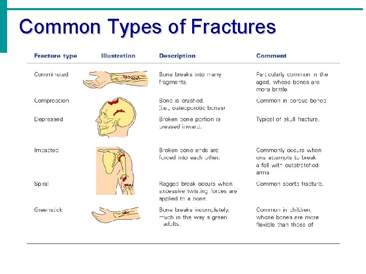 Common Types of Fractures 