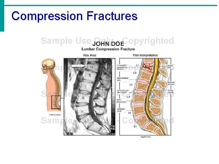 Compression Fractures 