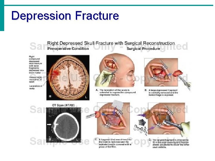 Depression Fracture 