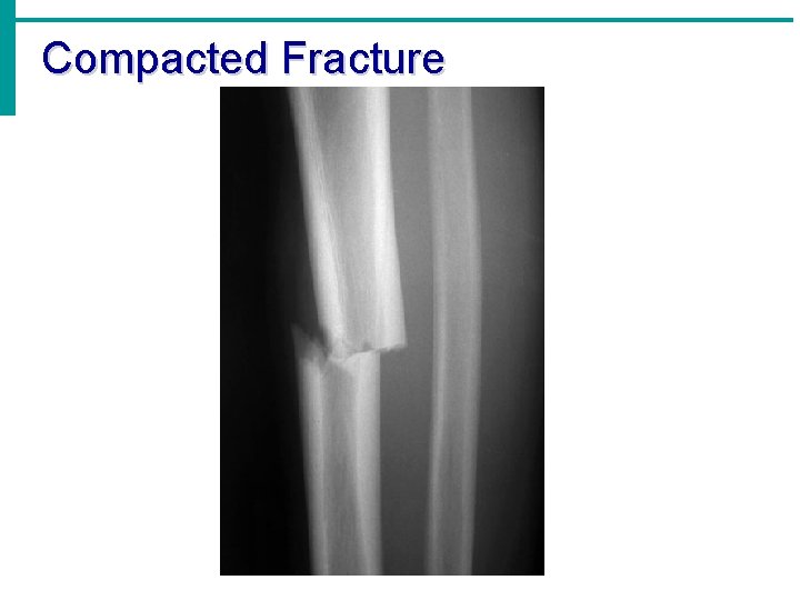 Compacted Fracture 
