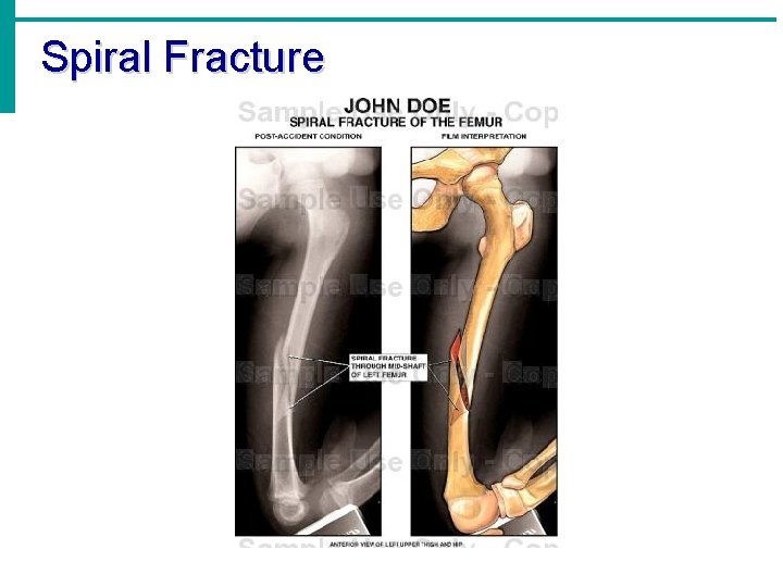 Spiral Fracture 