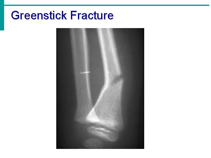 Greenstick Fracture 