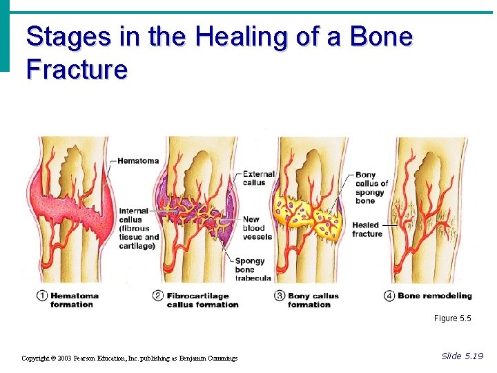 Stages in the Healing of a Bone Fracture Figure 5. 5 Copyright © 2003