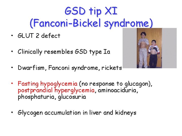 GSD tip XI (Fanconi-Bickel syndrome) • GLUT 2 defect • Clinically resembles GSD type