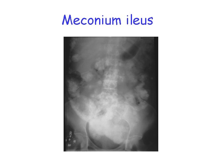 Meconium ileus 