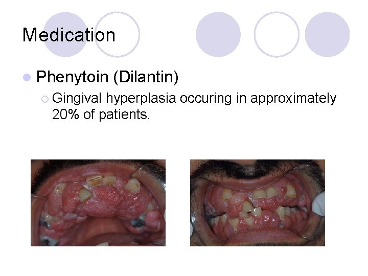 Medication l Phenytoin ¡ Gingival (Dilantin) hyperplasia occuring in approximately 20% of patients. 