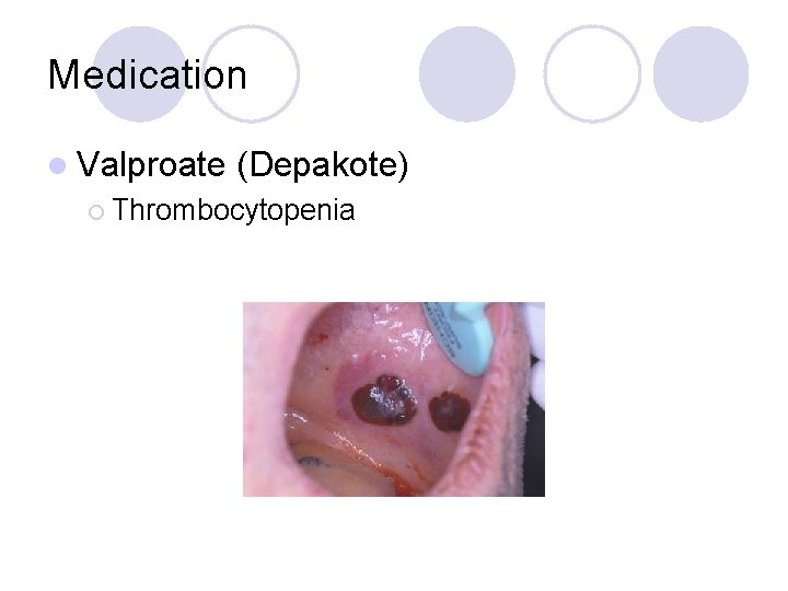 Medication l Valproate (Depakote) ¡ Thrombocytopenia 