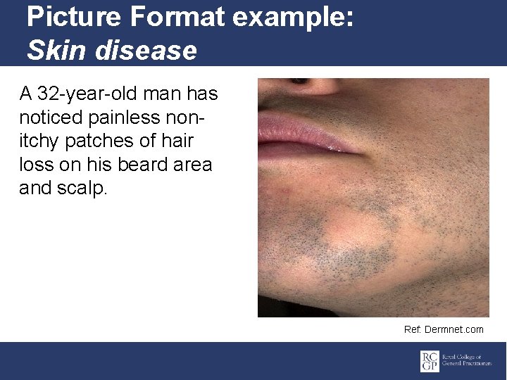 Picture Format example: Skin disease A 32 -year-old man has noticed painless nonitchy patches