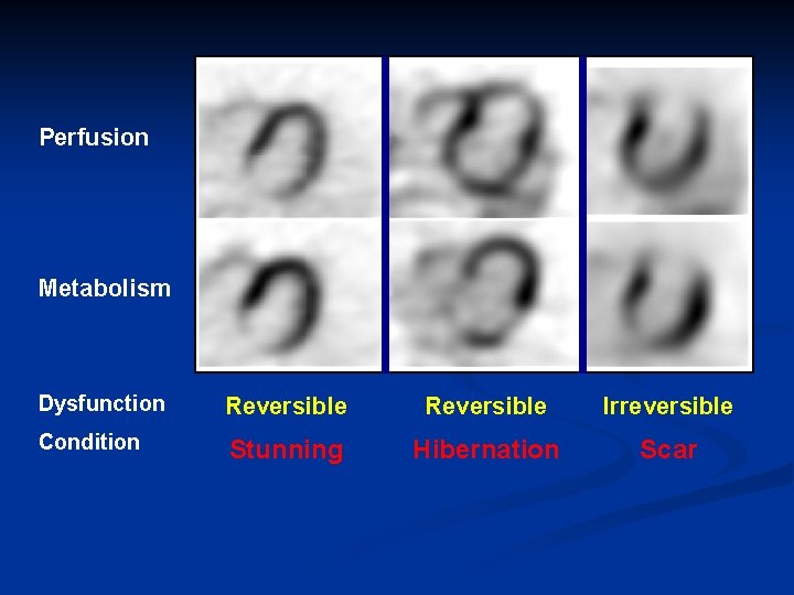 Perfusion Metabolism Dysfunction Reversible Irreversible Condition Stunning Hibernation Scar 