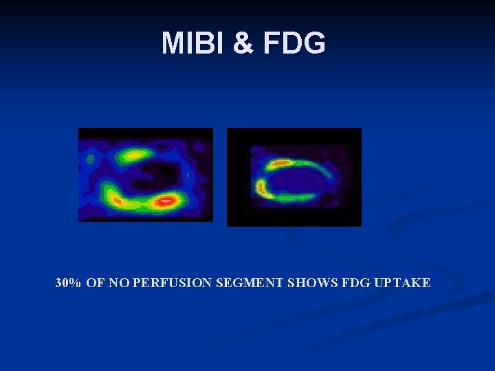 MIBI & FDG 30% OF NO PERFUSION SEGMENT SHOWS FDG UPTAKE 