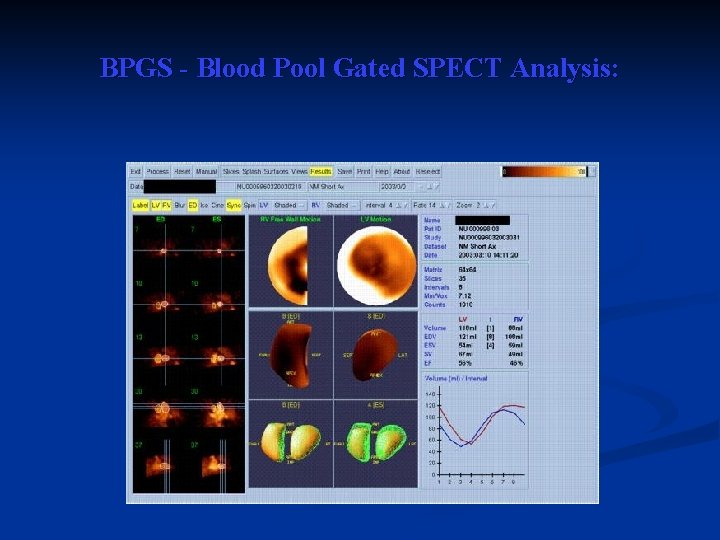BPGS - Blood Pool Gated SPECT Analysis: 