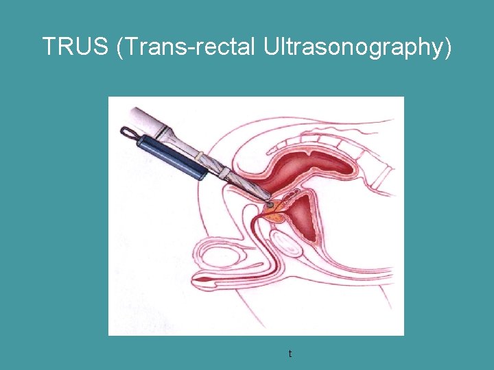 TRUS (Trans-rectal Ultrasonography) t 
