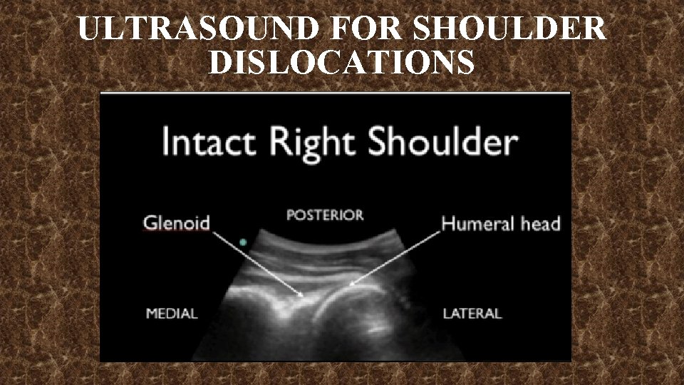 ULTRASOUND FOR SHOULDER DISLOCATIONS 