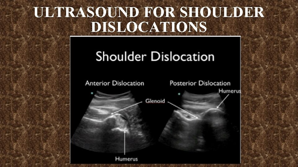 ULTRASOUND FOR SHOULDER DISLOCATIONS 