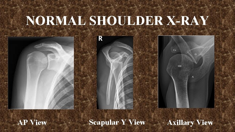 NORMAL SHOULDER X-RAY AP View Scapular Y View Axillary View 
