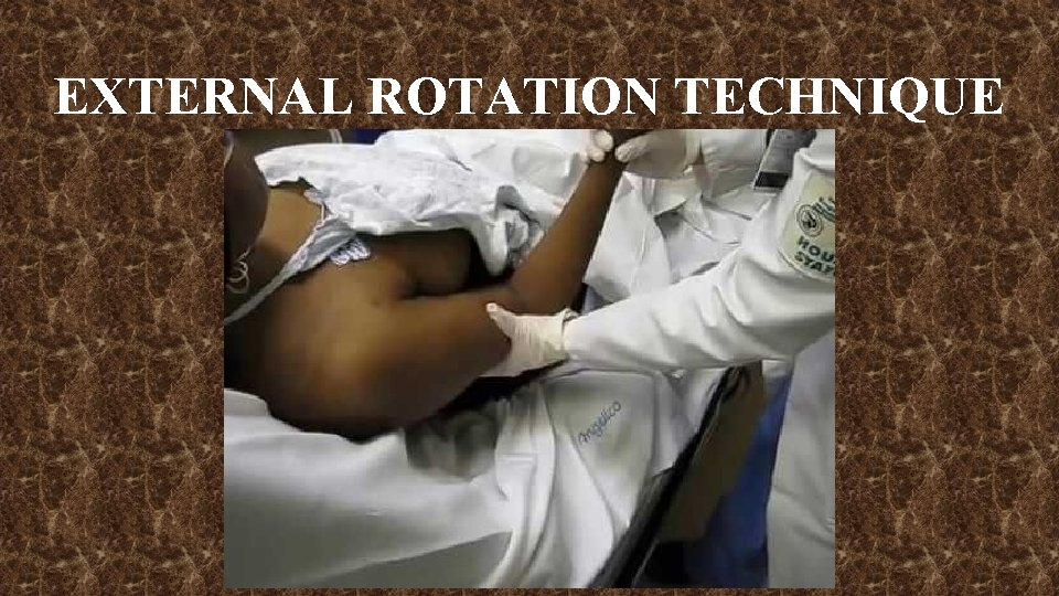 EXTERNAL ROTATION TECHNIQUE 