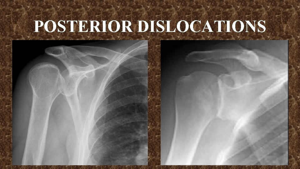 POSTERIOR DISLOCATIONS 