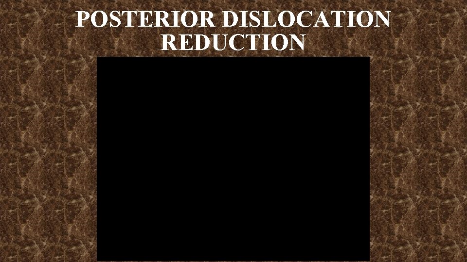 POSTERIOR DISLOCATION REDUCTION 