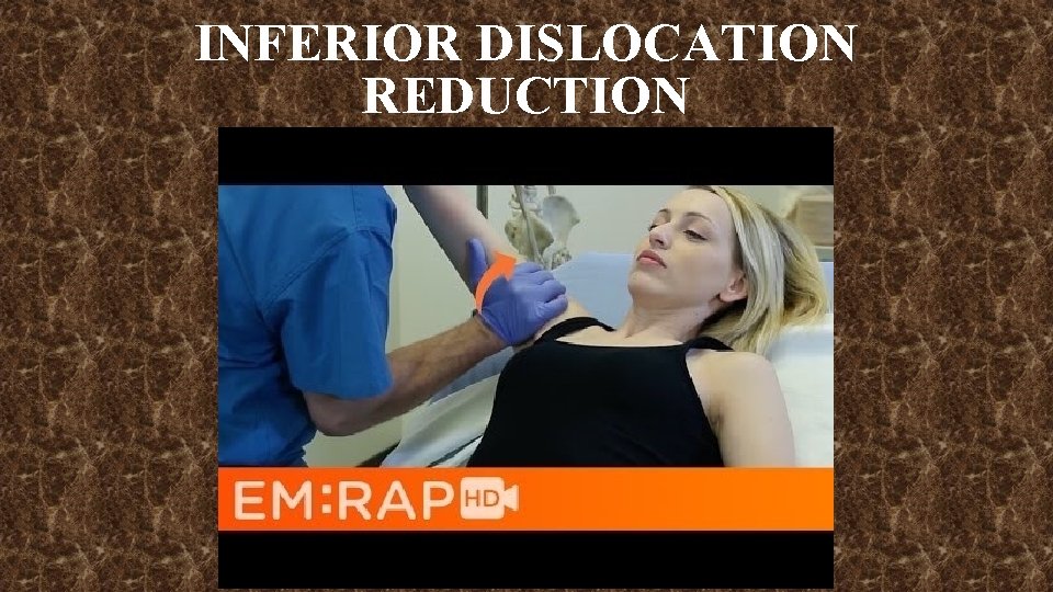 INFERIOR DISLOCATION REDUCTION 