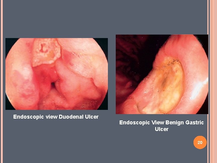 Endoscopic view Duodenal Ulcer Endoscopic View Benign Gastric Ulcer 20 