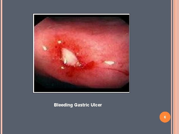 Bleeding Gastric Ulcer 6 