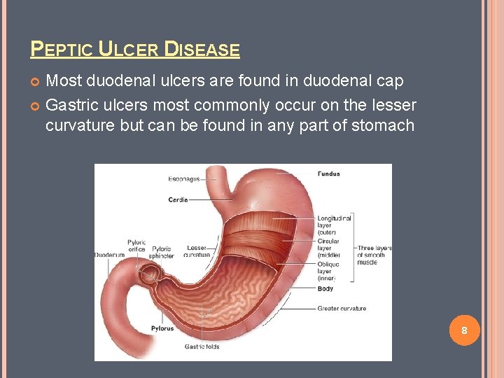 PEPTIC ULCER DISEASE Most duodenal ulcers are found in duodenal cap Gastric ulcers most