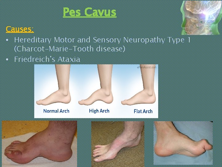 Pes Cavus Causes: • Hereditary Motor and Sensory Neuropathy Type 1 (Charcot-Marie-Tooth disease) •