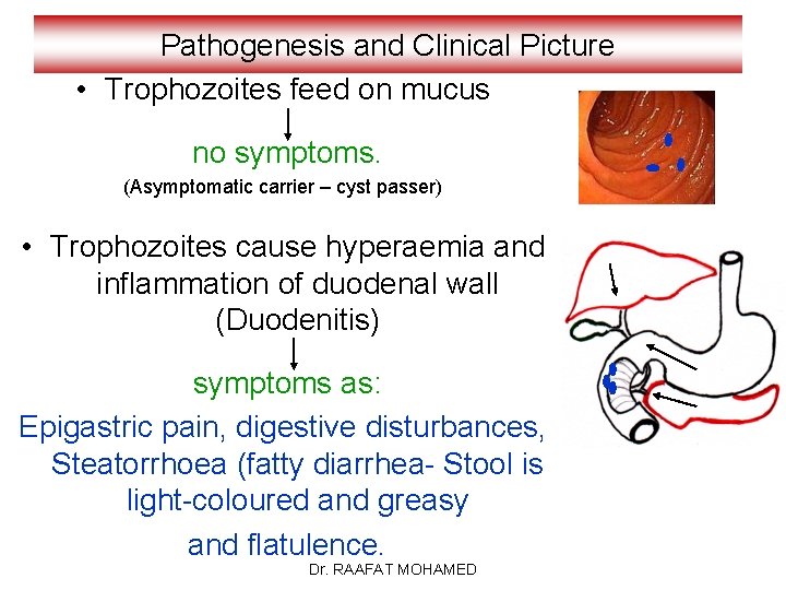 Pathogenesis and Clinical Picture • Trophozoites feed on mucus no symptoms. (Asymptomatic carrier –