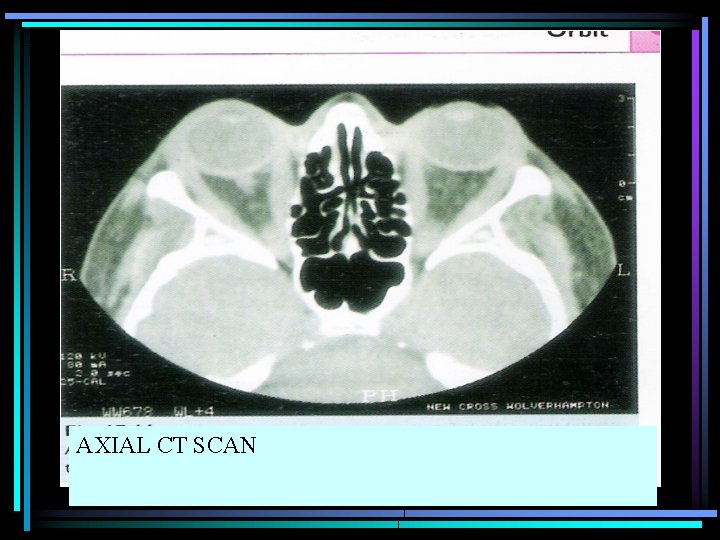 AXIAL CT SCAN 