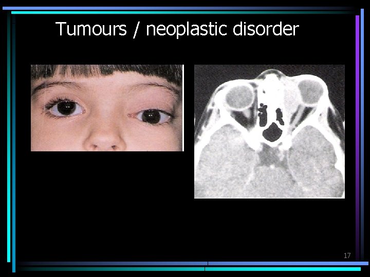 Tumours / neoplastic disorder 17 