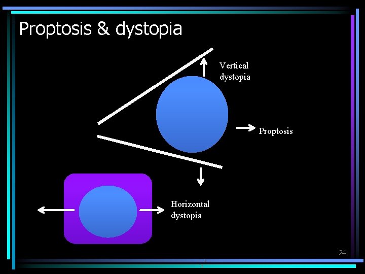 Proptosis & dystopia Vertical dystopia Proptosis Horizontal dystopia 24 