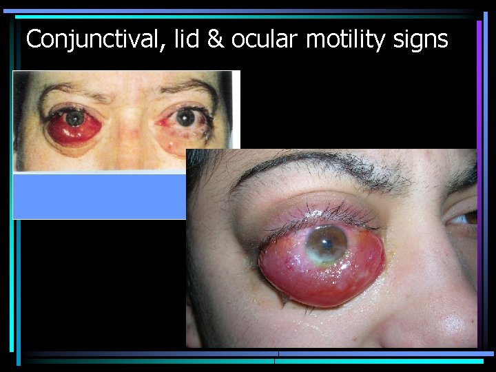 Conjunctival, lid & ocular motility signs 33 