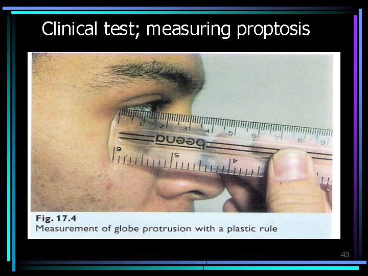 Clinical test; measuring proptosis 43 