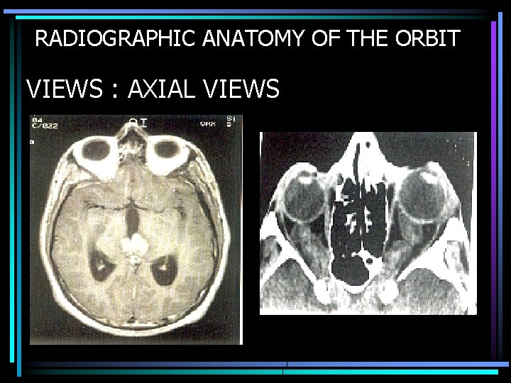 RADIOGRAPHIC ANATOMY OF THE ORBIT VIEWS : AXIAL VIEWS 