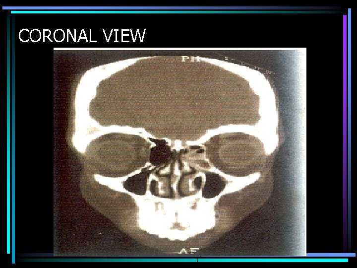 CORONAL VIEW 