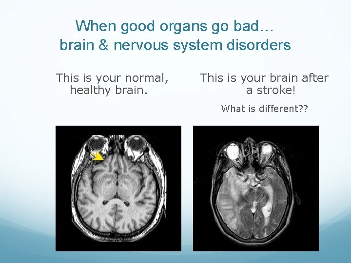 When good organs go bad… brain & nervous system disorders This is your normal,