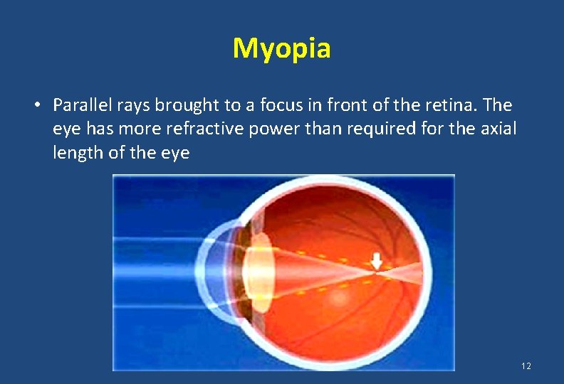 Myopia • Parallel rays brought to a focus in front of the retina. The