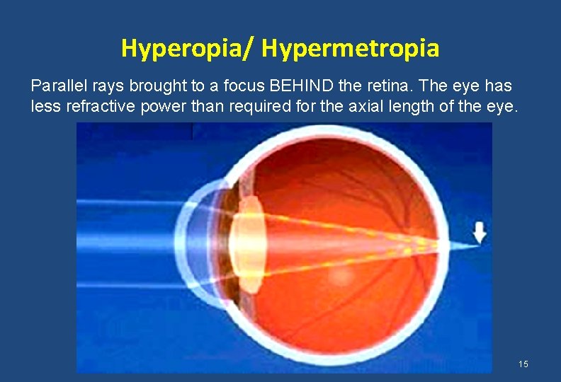 Hyperopia/ Hypermetropia Parallel rays brought to a focus BEHIND the retina. The eye has