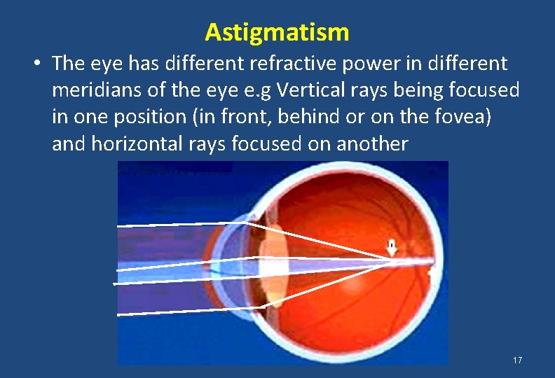 Astigmatism • The eye has different refractive power in different meridians of the eye