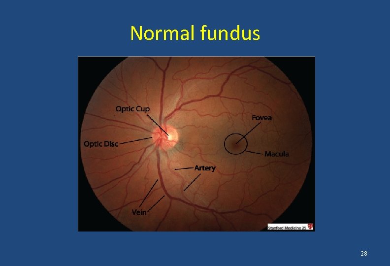 Normal fundus 28 