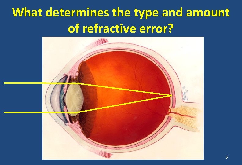 What determines the type and amount of refractive error? 6 