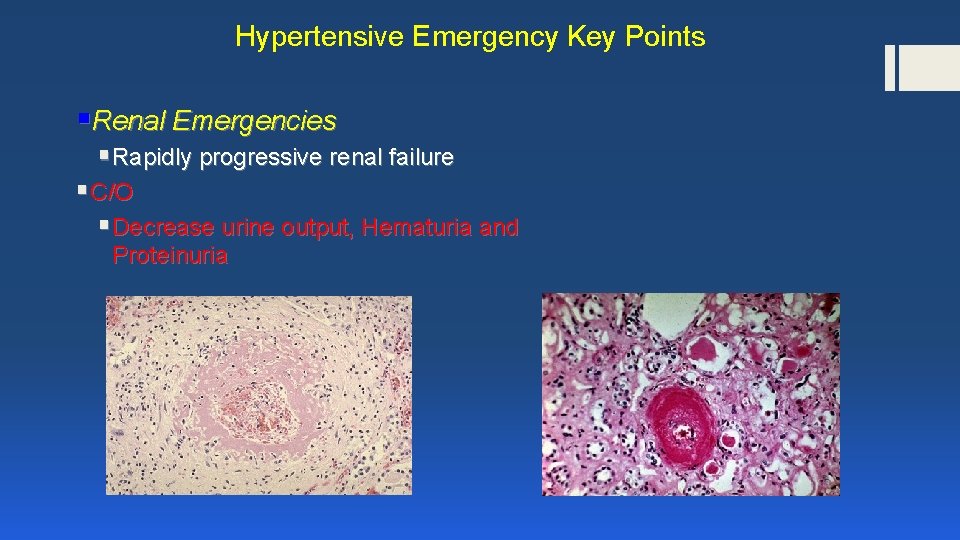 Hypertensive Emergency Key Points §Renal Emergencies § Rapidly progressive renal failure § C/O §